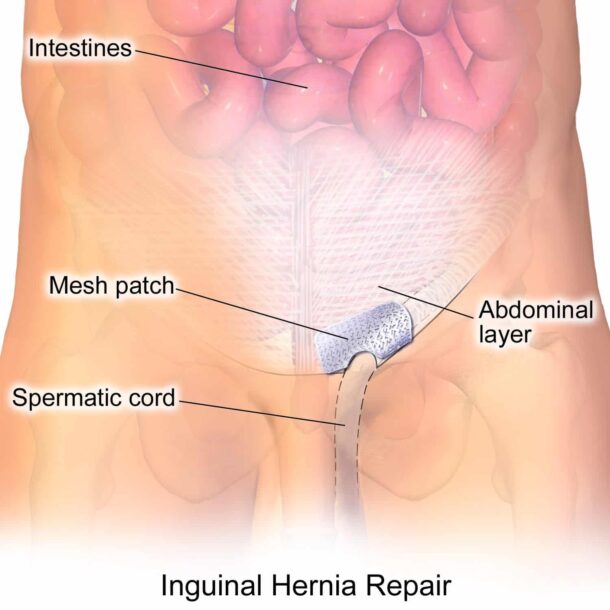 inguinal hernia repair