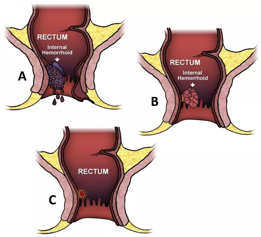 hemorrhoids-bleeding