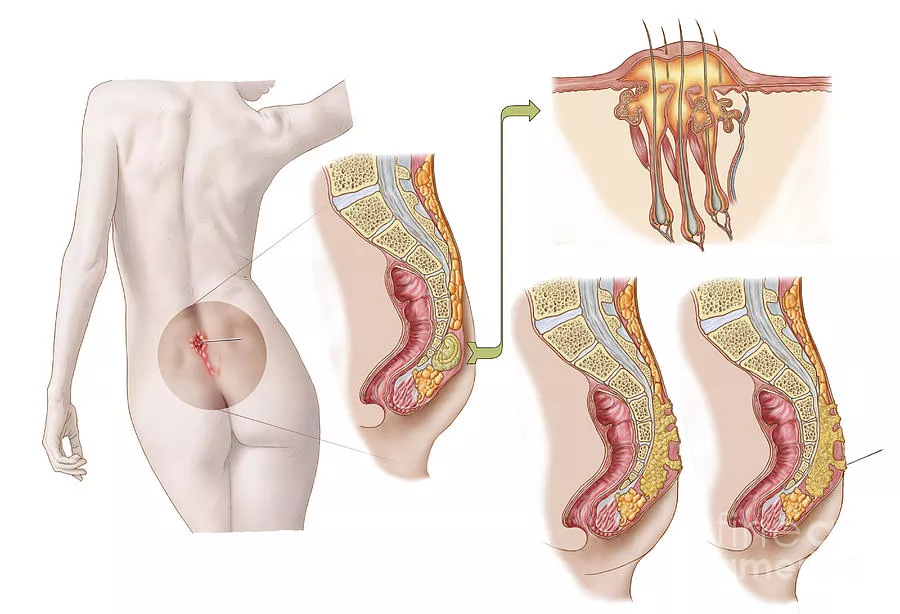 Pilonidal Cyst, Tailbone Cyst